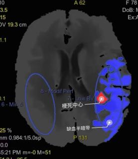 头颅CTA+ CTP一站式成像