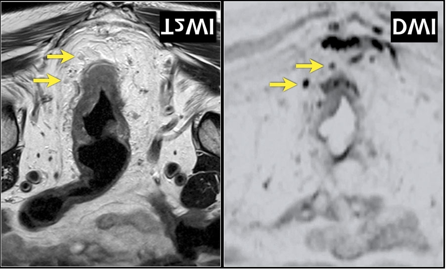 术前直肠癌的评估——高分辨直肠MRI