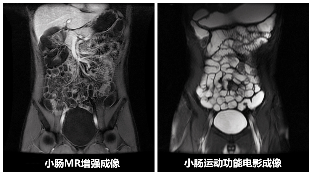 小肠MR增强成像_副本.jpg