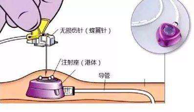 我院成功开展输液港维护技术，填补我院静脉治疗领域又一空白